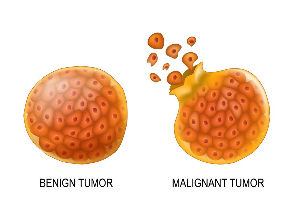 Benign tumor treatment at ahura nursing home