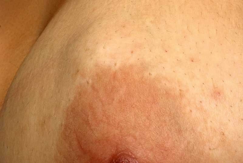 Breast lump treatment options at ahura nursing home