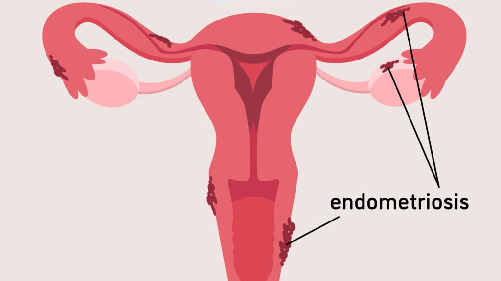 Endometriosis at ahura nursing home in malad west