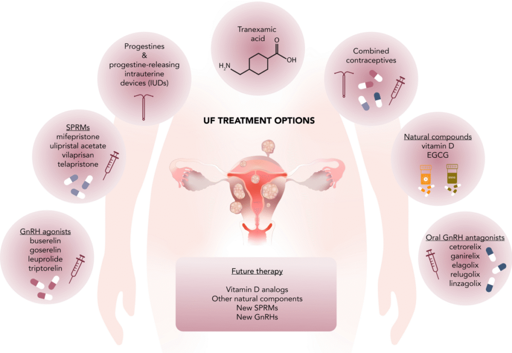 Fibriod management and uf treatment options